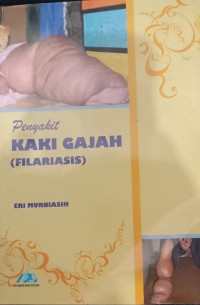 Image of Penyakit Kaki Gajah (Filariasis)